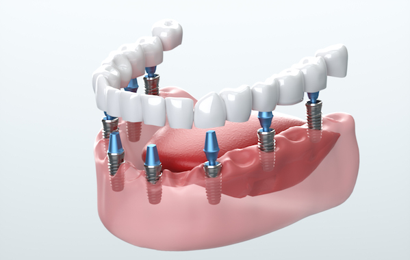 What to Consider Before Planning a Long-Term Tooth Replacement