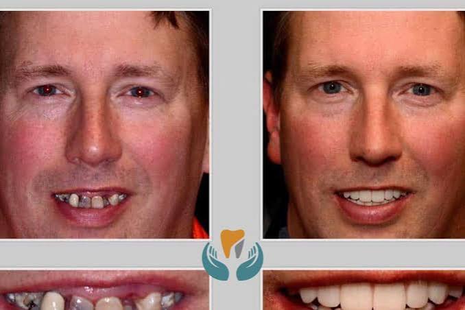 How Dentists Repair Small Defects Without Covering The Entire Tooth